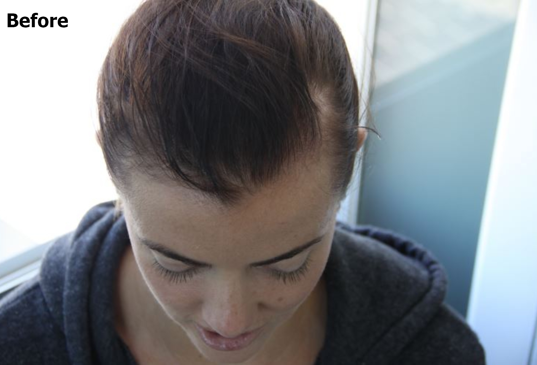 a before picture of a woman with hair thinning 
