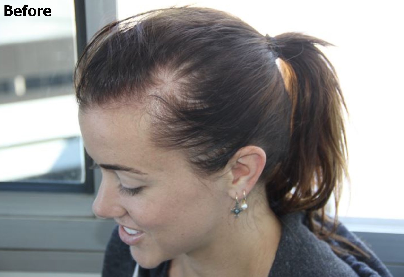 a before picture of a woman with hair thinning 