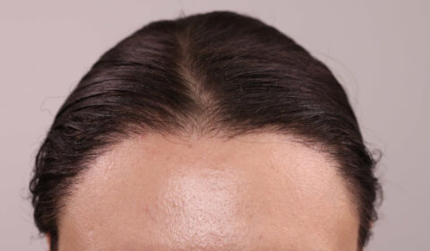 Hair Transplants for Women: Achieving the Hairline You Desire With the FUE Hair Transplant Procedure
