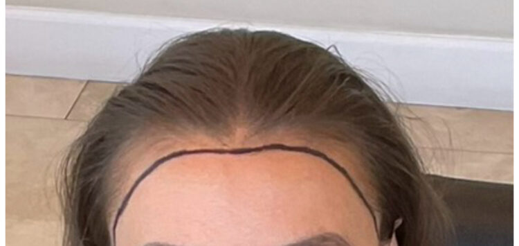 a before and an after shot of a woman's hairline