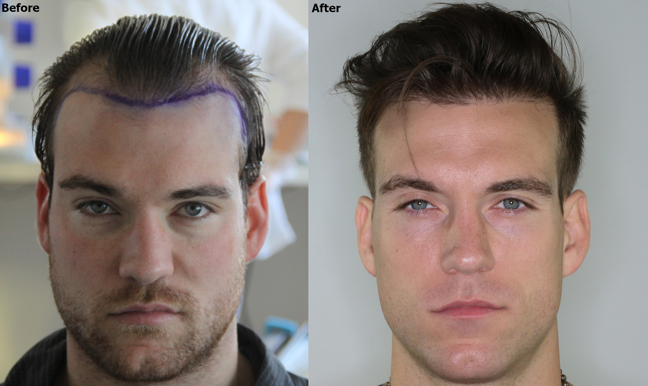 a before and after shot of a male's hairline