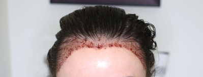 image of the hairline after the transplant is done 