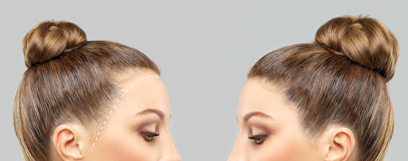 A side-by-side comparison image of a girl with a bun hairstyle, illustrating her appearance before and after achieving the desired fullness following a hair transplant  for women with her hair health.
