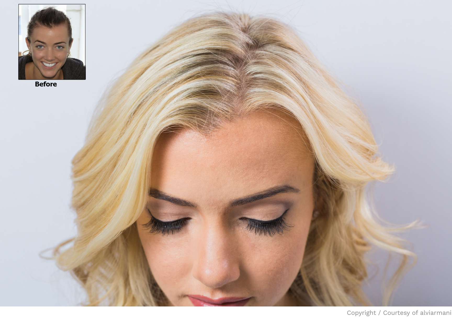 A before-and-after comparison showcasing a girl whose hair has been filled in through a follicular unit hair transplant for women.