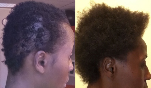 Tresses in Distress: Exploring Effective Hair Loss Management Options
