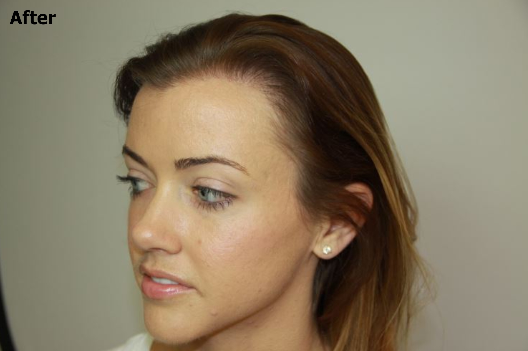 a side profile of an image after a hair procedure with improved hair 