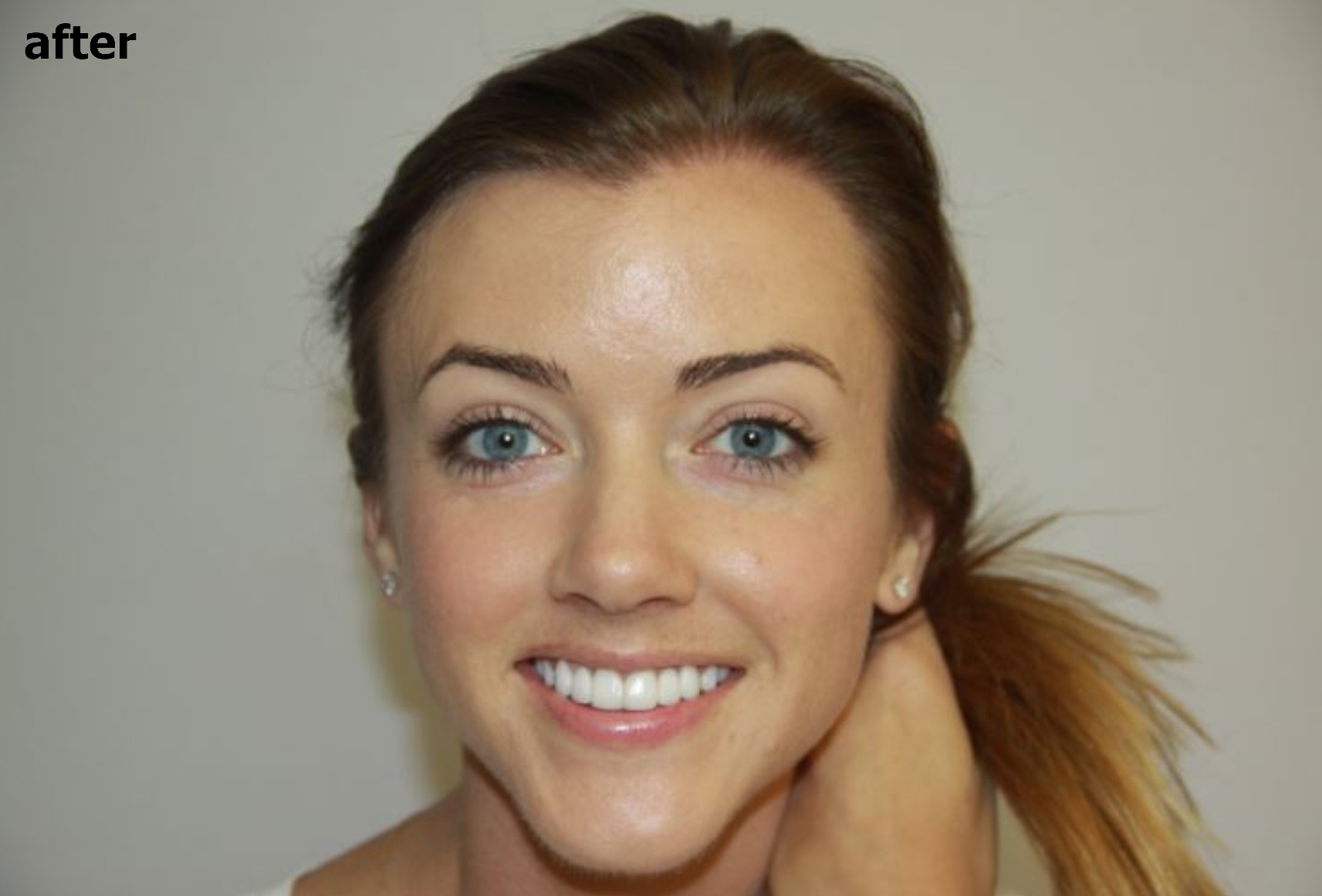 an image of a satisfied woman after improved hairline and volumized hair 
