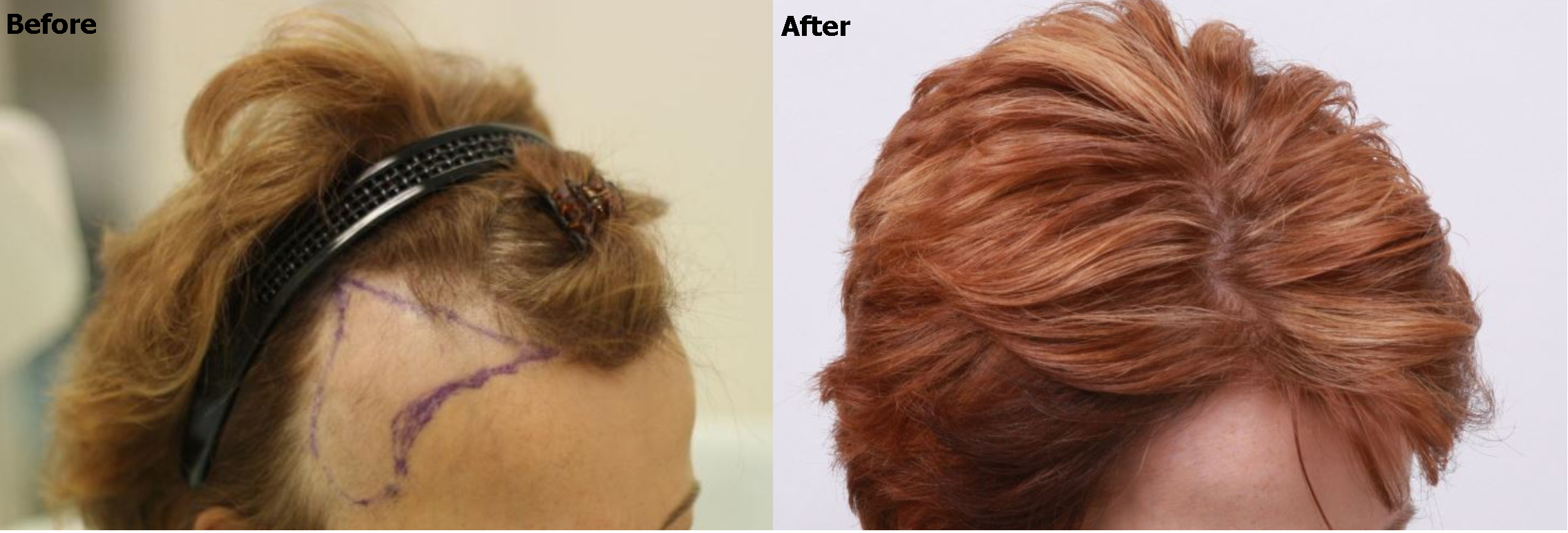 a before and after image of a woman with temple recession and a fuller head after restoration 