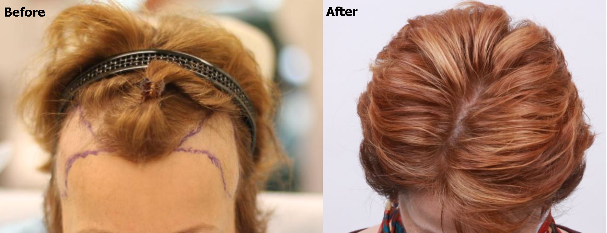 a before and after image of a woman with temple recession and a fuller head after restoration 