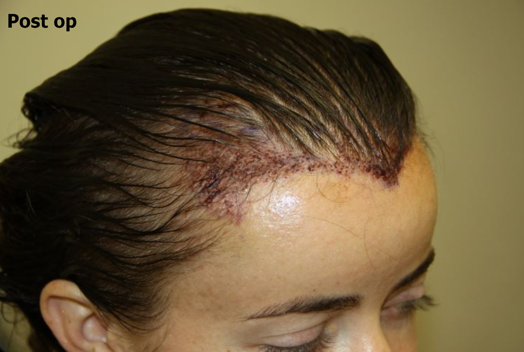 an after picture of a woman with restored hairline 