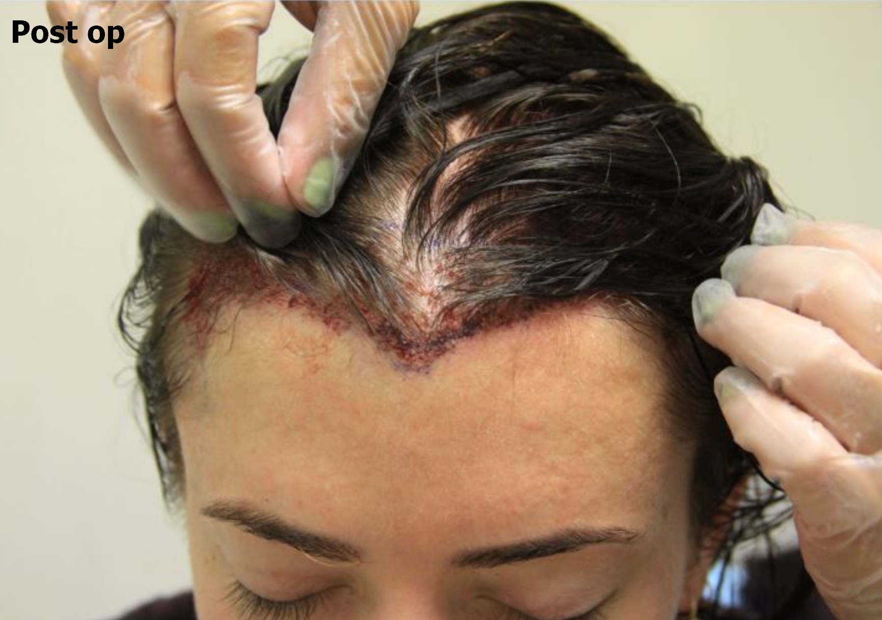 an after picture of a woman with restored hairline 