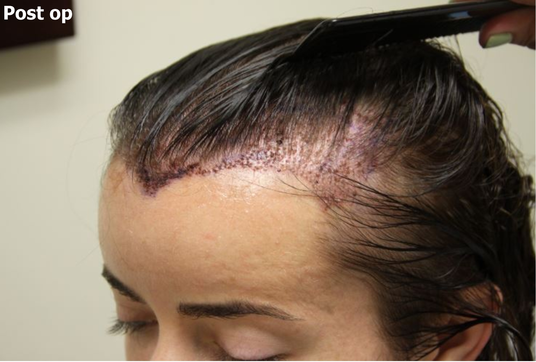 an after picture of a woman with restored hairline 