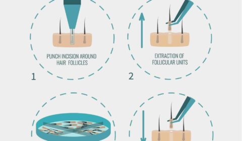Is FUE Hair Transplant Suitable For Women and When?